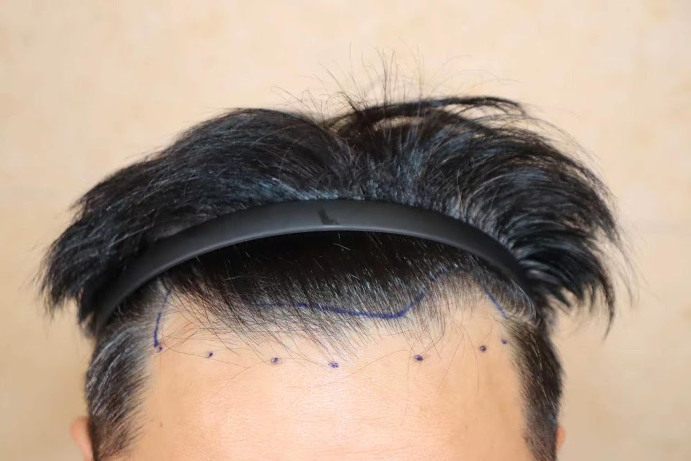 woomchan hair transplant English-speaking — clinic photo 2