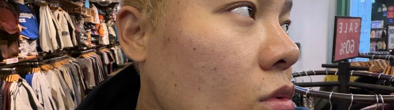 오블리주의원 홍대 | dermatology near me Ohvelyjoo Clinic hongdae skin clinic | Rejuran | ultherapy | オブリージュクリニック サーマクール | 歐薇麗珠診所 clinic