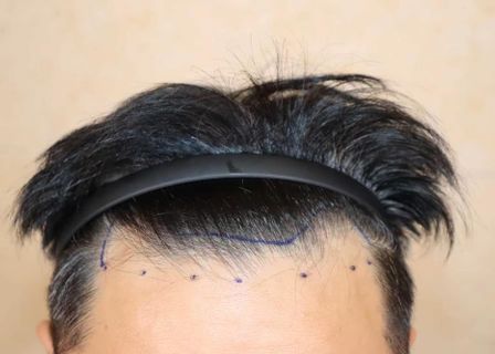 woomchan hair transplant English-speaking — clinic photo 2